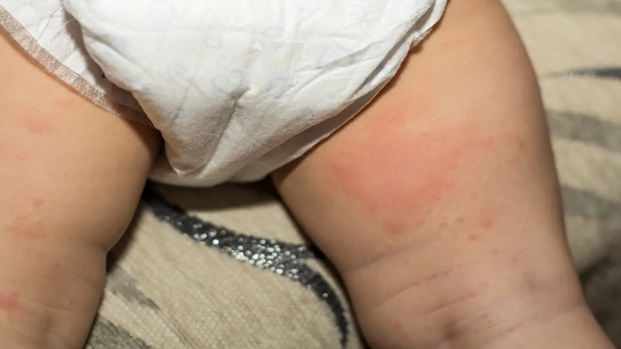 Dealing With Diaper Rash And Skin Irritation