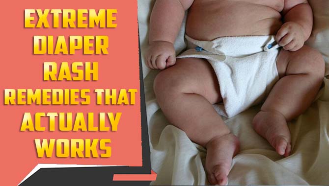 Extreme Diaper Rash Remedies That Actually Work