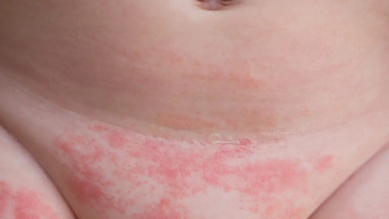 Identifying The Causes Of Severe Diaper Rash