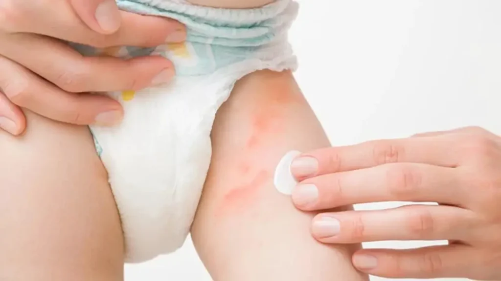 So What Causes Diaper Rash In Newborns