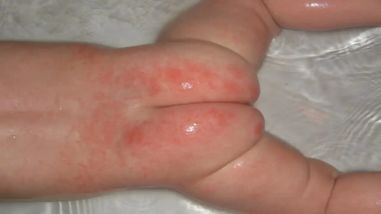 What's Good For The Baby Rash On The Bottom